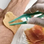 شستشوی زخم عفونی، گامی مهم در جلوگیری از عفونت